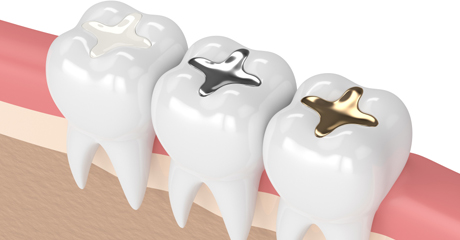 Fix Cavities Between Teeth